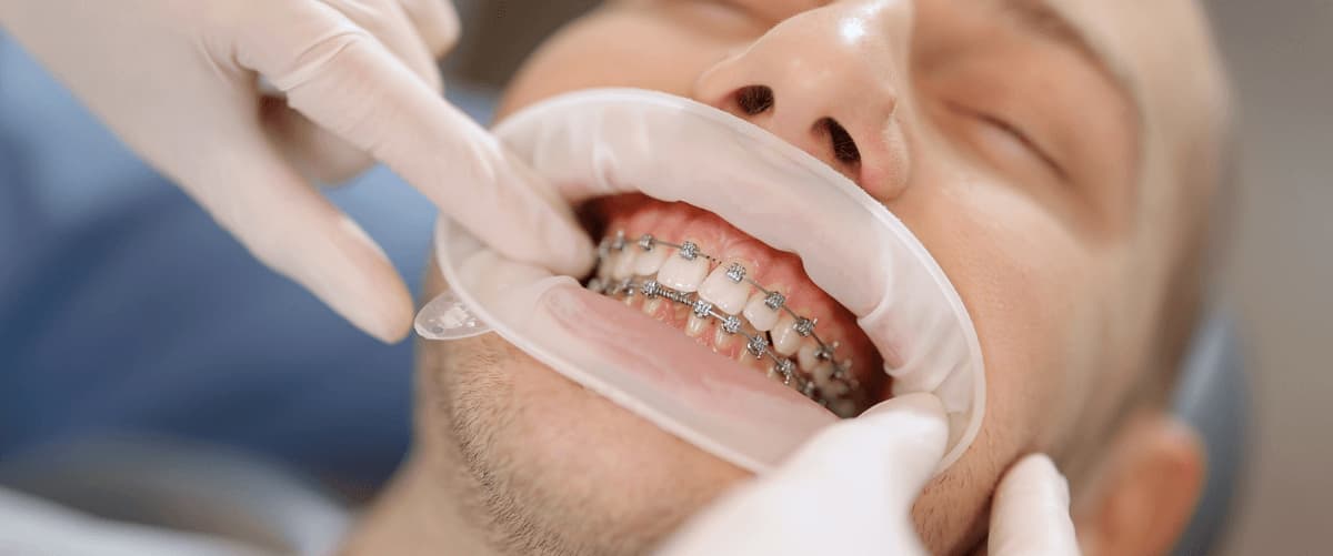 Zahnzusatzversicherung Zahnspange – Kosten & Leistungen